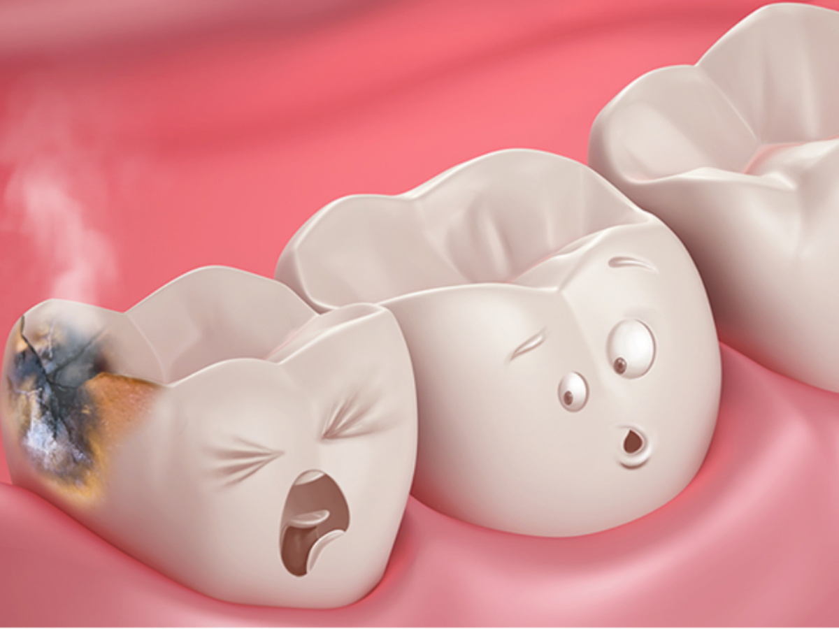 Dental Cavity - Germs or Worms - Dr. Gaurav Malik - Max Dental Care | Best  Dentist in Mohali